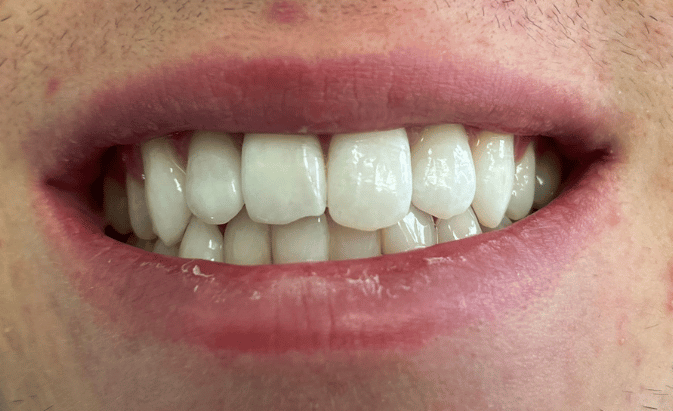 After - Hanwell Dental Centre